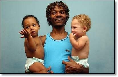 Médicos afirmam que é um caso raro, ilustrado nos livros de medicina com gêmeos de duas cores. (Foto: Reprodução)