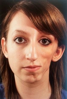 Jovem começou a desenvolver a síndrome quando tinha 7 anos. (Foto: Reprodução)