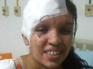 Aline com parte da testa e ombro cobertos após cirurgia. (Crédito: Reprodução)