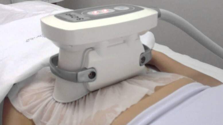 Clínicas e sites explicam na internet que a criolipólise é o “novo método de esculpir o corpo”. Sócio diz que produto não é vendido no País. (Foto: Reprodução)