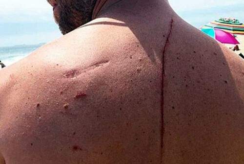 Americano ficou ferido pelo ataque do tubarão. (Foto: Reprodução)