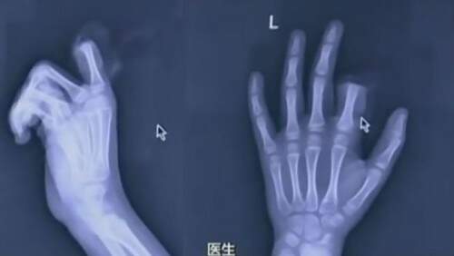 Médicos que fizeram a cirurgia de recolocação do membro não garantiram se a operação foi um sucesso. (Crédito: Reprodução)