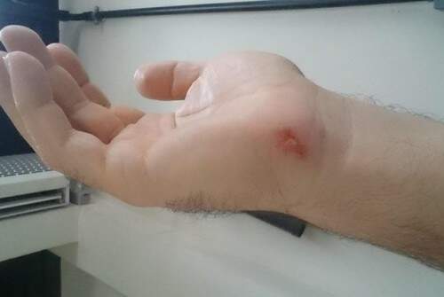 Juiz Ronald Pietre alega que também atacado pela dona do restaurante que discutiu com ele e mostrou marcas de agressão em sua mão. (Crédito: Reprodução)