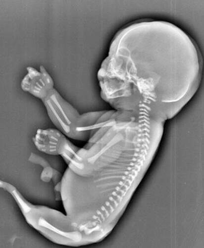Ela optou pelo aborto após os médicos indicarem que a criança não seria capaz de sobreviver. (Foto: Reprodução)