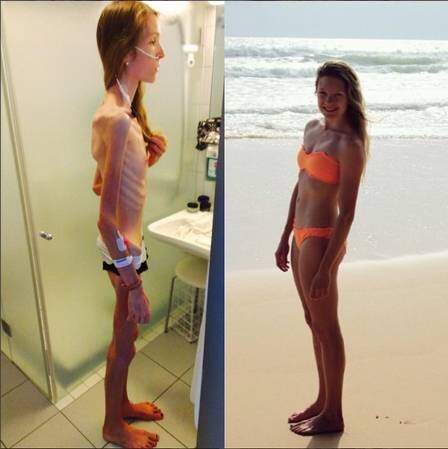Hannah quando teve anorexia e agora mais saudável. (Foto: Instagram / Reprodução)