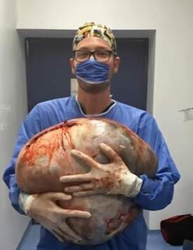 Médico de 27 anos posou com o cisto gigante depois da cirurgia. (Foto: Reprodução)