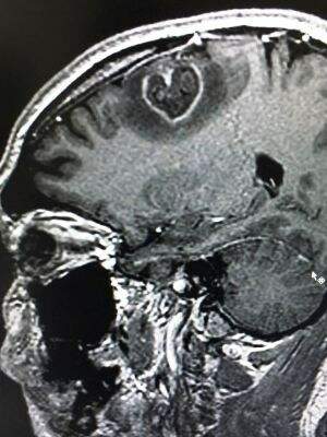 Tumor em forma perfeita de coração foi retirado do cérebro. (Foto: Arquivo Pessoal)