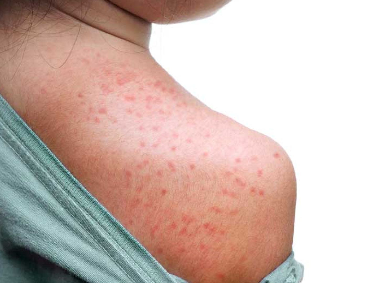 Alerta: Porto Alegre reforça vacinação contra o sarampo 🚨